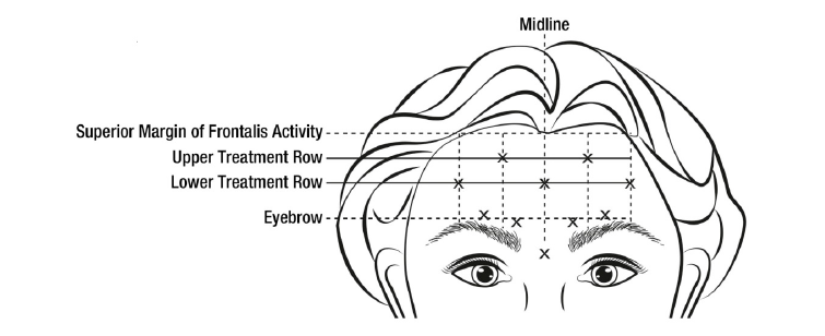 Botox Dosage Image 3