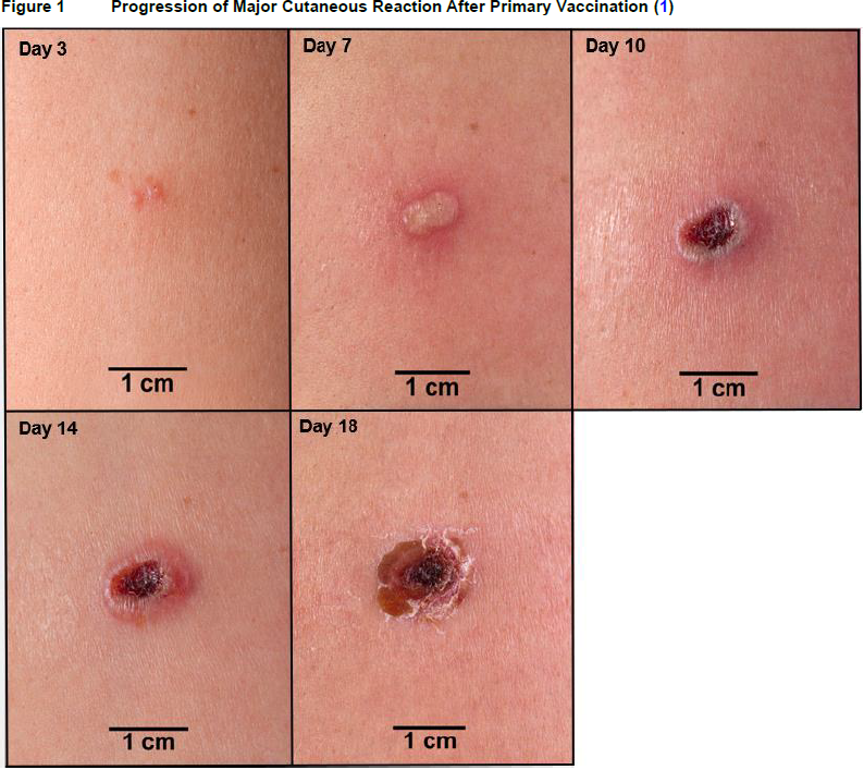 ACAM2000 Dosage Image 1