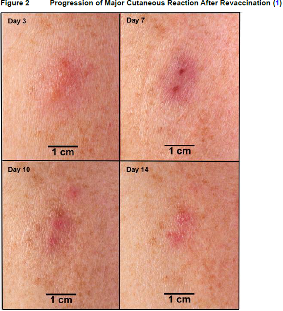 ACAM2000 Dosage Image 2