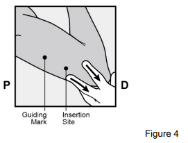 Implanon Dosage Figure 4