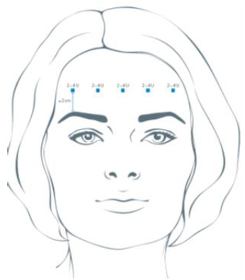 Xeomin Dosage Image 4