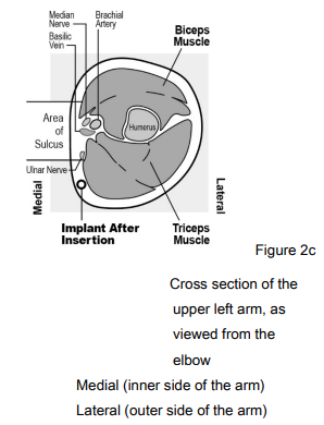 Implanon Dosage Figure 2c